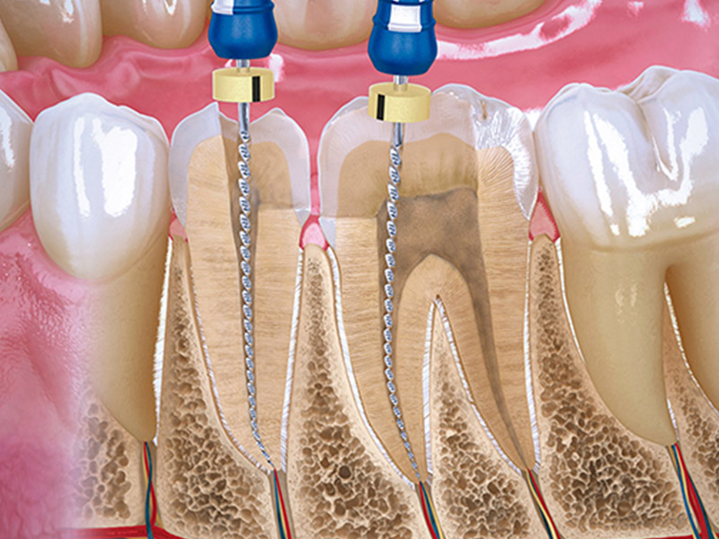 Endodoncia